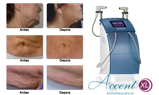 Accent Xl - O antes e depois da melhor radiofreqencia do mercado. S na Laser Mix Locao de Equipamentos de Esttica no Rio de Janeiro e Grande Rio, www.lasermix.net.br / (21) 97981-0008