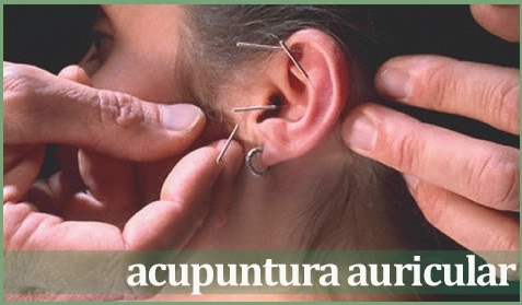 Acupuntura Auricular