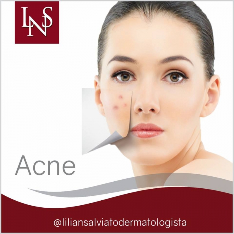 Tratamento de Acne