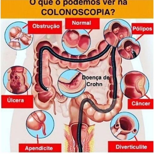 Colonoscopia em Vitória - ES