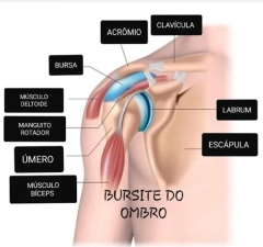 Massagem para bursite em São José (SC)