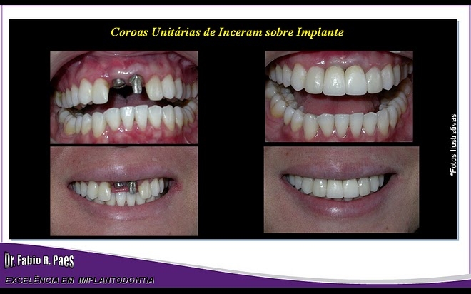 Implantes Realizados