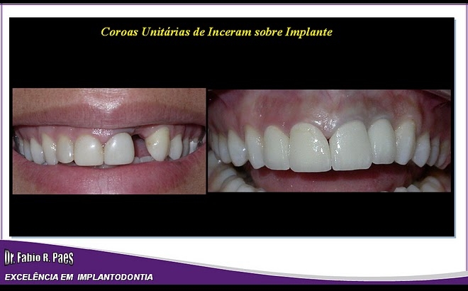 Implantes Realizados