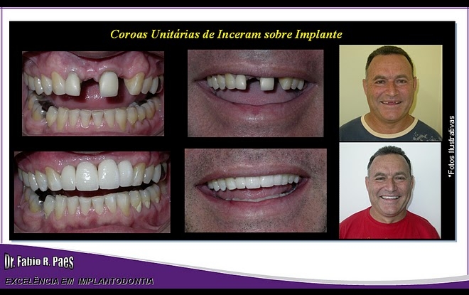 Implantes Realizados