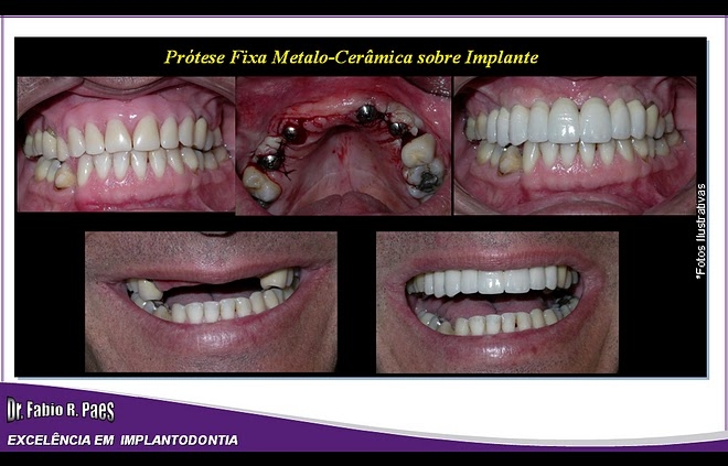 Implantes Realizados