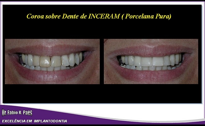 Implantes Realizados