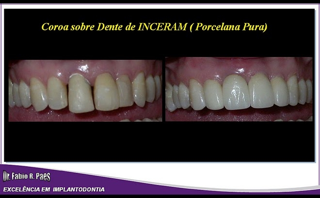 Implantes Realizados