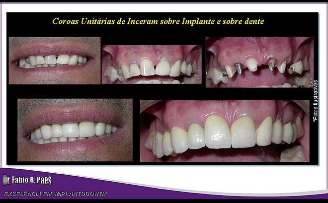 Implantes Realizados