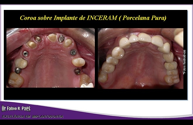 Implantes Realizados